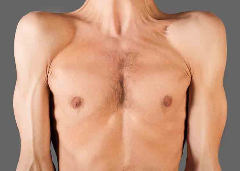 Bad Chest Bad Chest Genetics: What Are the Signs & Can You Fix Them? | Flex AI